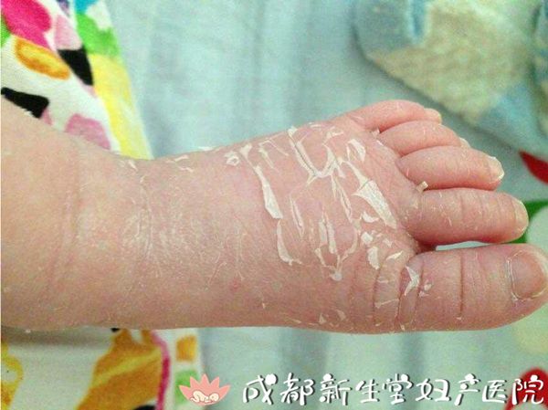  成都妇产医院,成都高水平的产科医院,成都专业的妇产医院,新生堂妇产医院，成都顺产医院，瘢痕子宫，母乳喂养，侧切 ，新生儿脱皮