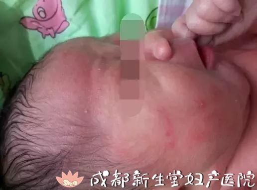成都妇产医院,成都高水平的产科医院,成都专业的妇产医院,新生堂妇产医院，成都顺产医院，瘢痕子宫顺产医院，母乳喂养高的医院，侧切低的医院，新生儿红斑