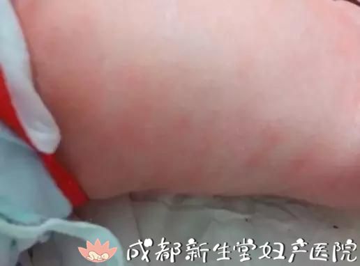 成都妇产医院,成都高水平的产科医院,成都专业的妇产医院,新生堂妇产医院，成都顺产医院，瘢痕子宫顺产医院，母乳喂养高的医院，侧切低的医院，新生儿红斑
