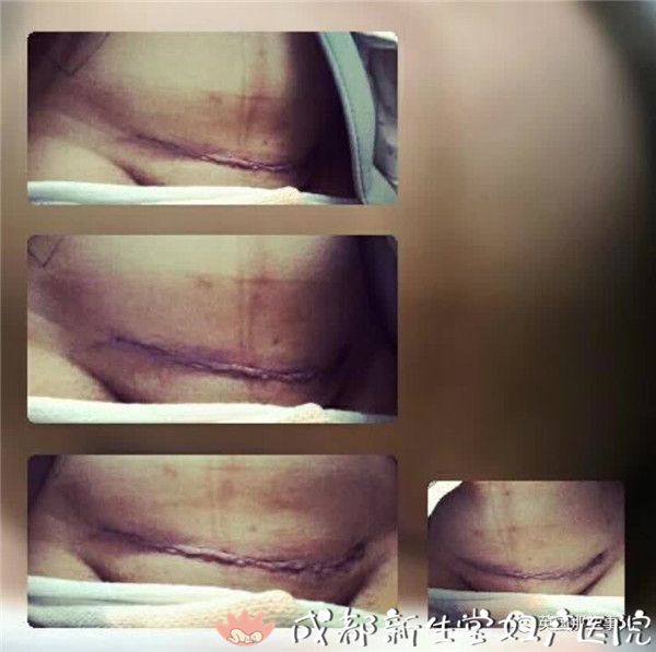 成都顺产医院,瘢痕子宫顺产医院,母乳喂养高的医院,侧切低的医院