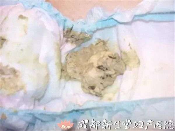 一个是宝宝大便呈现为白陶土样大便,就像下面的大便颜色.