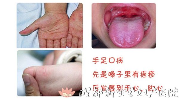 真假手足口,傻傻分不清的宝妈请进!