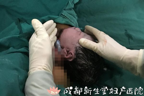 成都妇产医院,成都高水平的产科医院,成都专业的妇产医院,脐带绕颈,脐带绕足