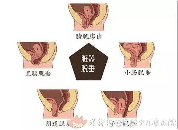 女性的盆底肌肉像吊床一样,承托和支持着膀胱,子宫,直肠等人体重要