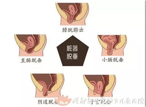 女性膀胱突出图片